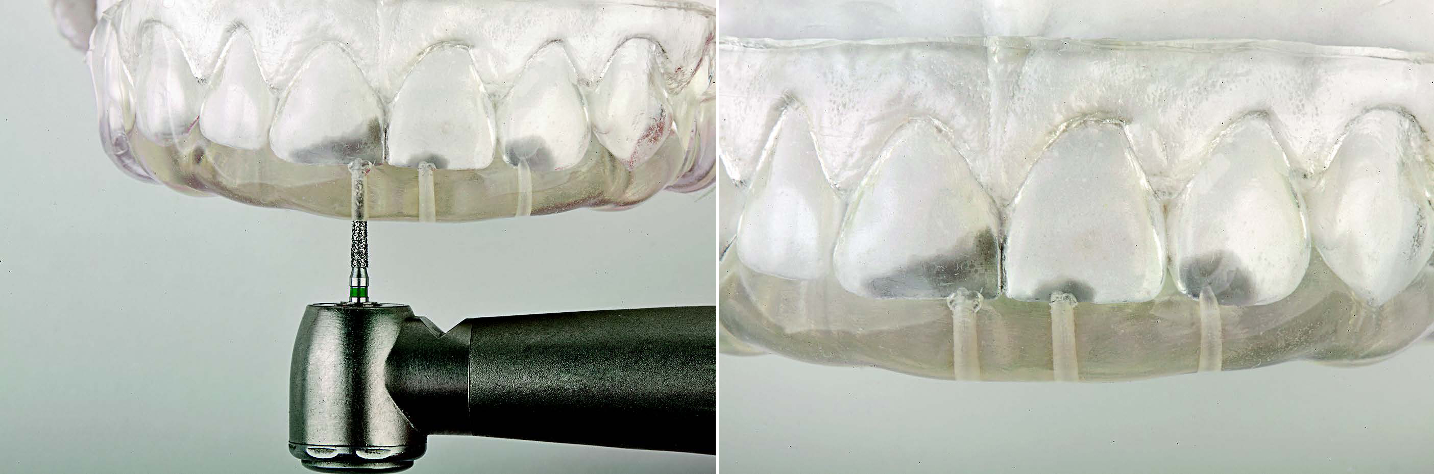 A clear PVS matrix (Exaclear, GC America) was fabricated to replicate the diagnostic wax-up using a nonperforated tray. A small opening was made above each tooth that was to be restored using a tapered diamond bur (6847, Brasseler USA).