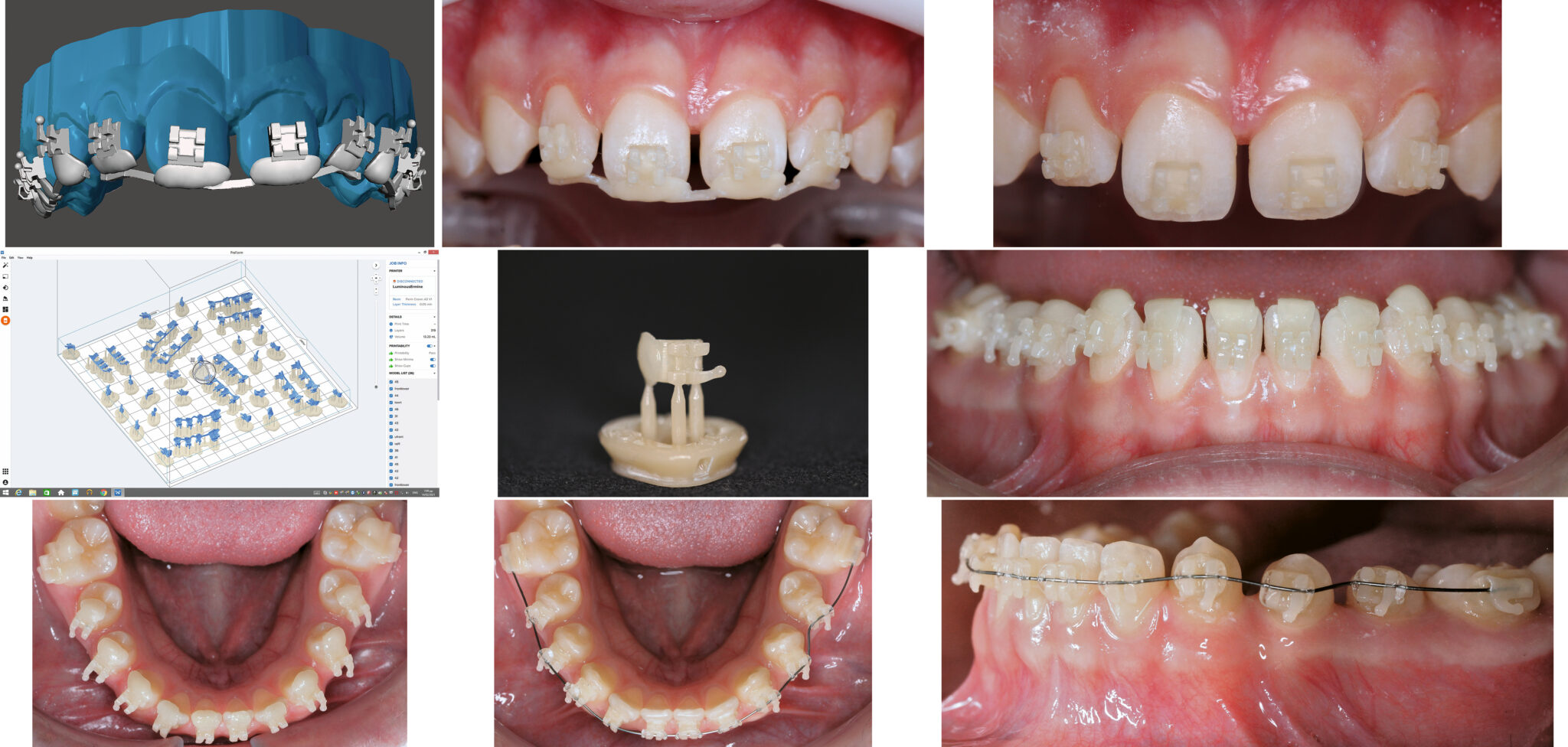 Design and Print Your Own Customized Orthodontic Brackets ...